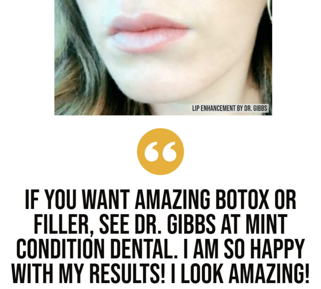 Juvéderm – Dermal Filler